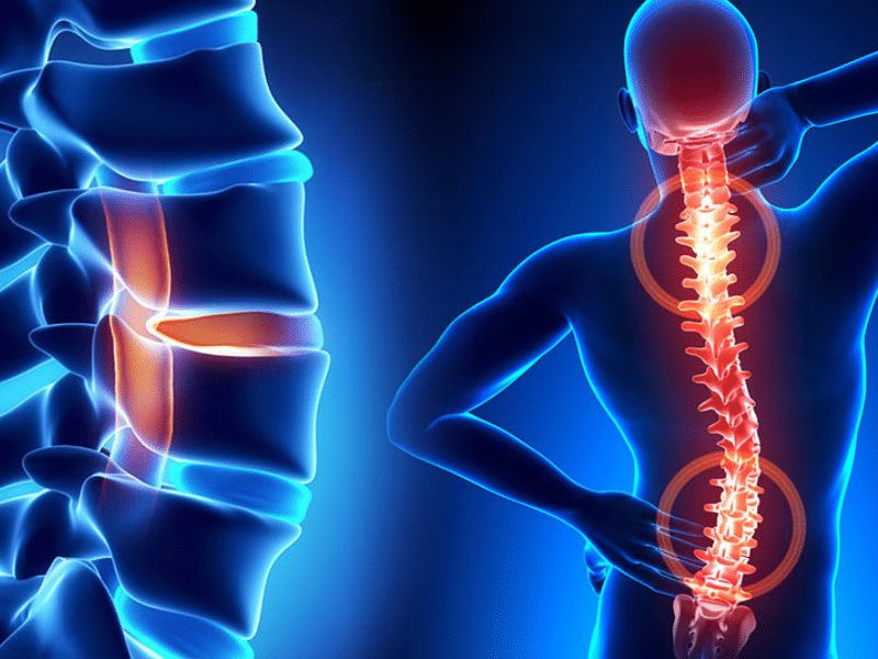 Tình trạng thoái hóa cột sống liên quan đến sự hao mòn dần dần của đĩa đệm, khớp và xương cột sống