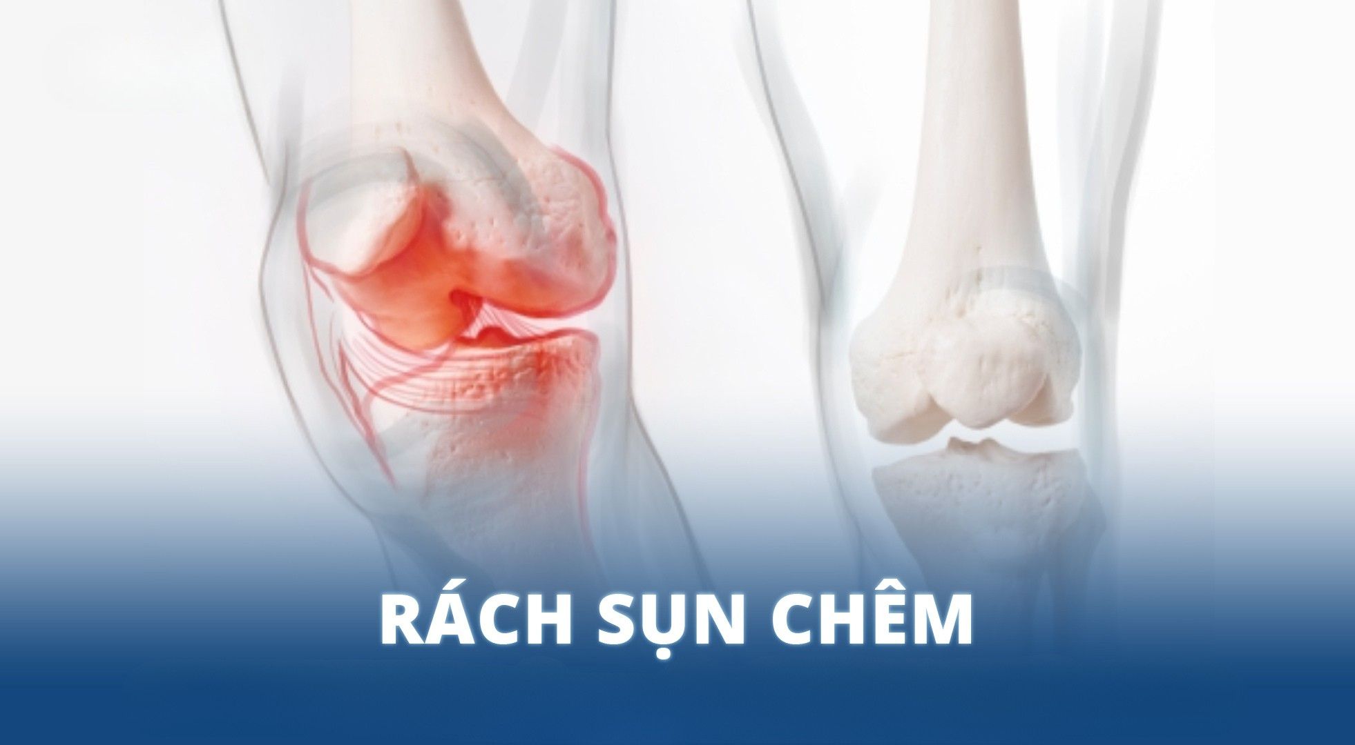 Chấn thương dây chằng đầu gối: Cách nhận biết và điều trị hiệu quả