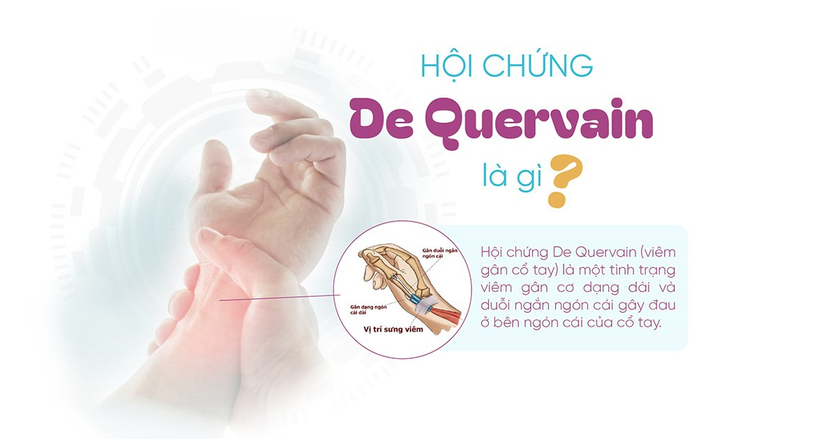 Hội chứng De Quervain