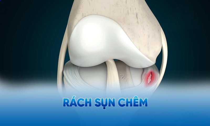 Rách sụn chêm là một trong những chấn thương phổ biến ở đầu gối