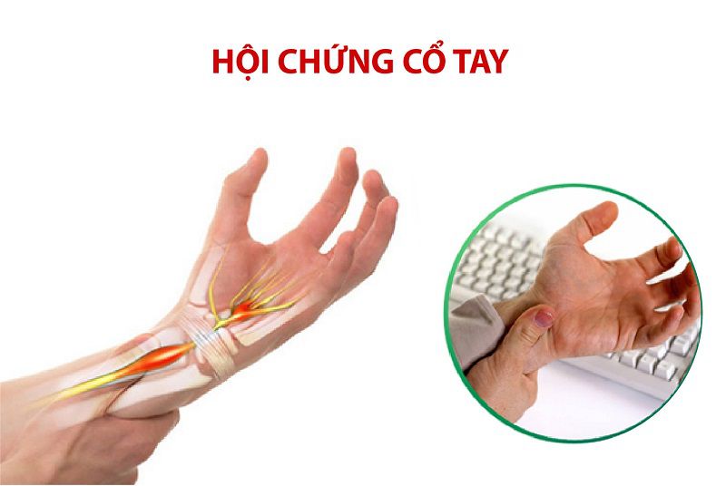 hội chứng ống cổ tay là gì