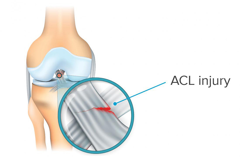 Rách dây chằng chéo trước có tự lành không?