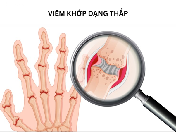 Viêm khớp dạng thấp: Triệu chứng, nguyên nhân và cách phòng ngừa