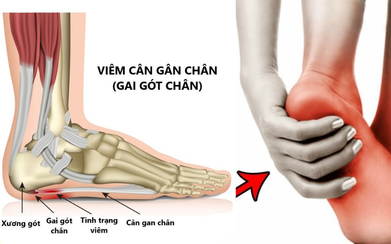 Triệu chứng viêm cân gân chân