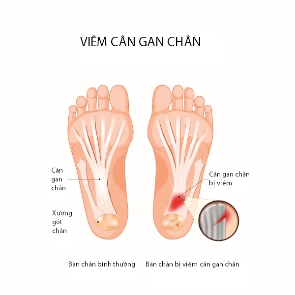 Viêm cân gan chân: Nguyên nhân, triệu chứng, chẩn đoán và điều trị
