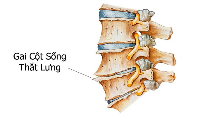 Tổng hợp thông tin về bệnh gai cột sống lưng và cách chữa trị. XEM NGAY