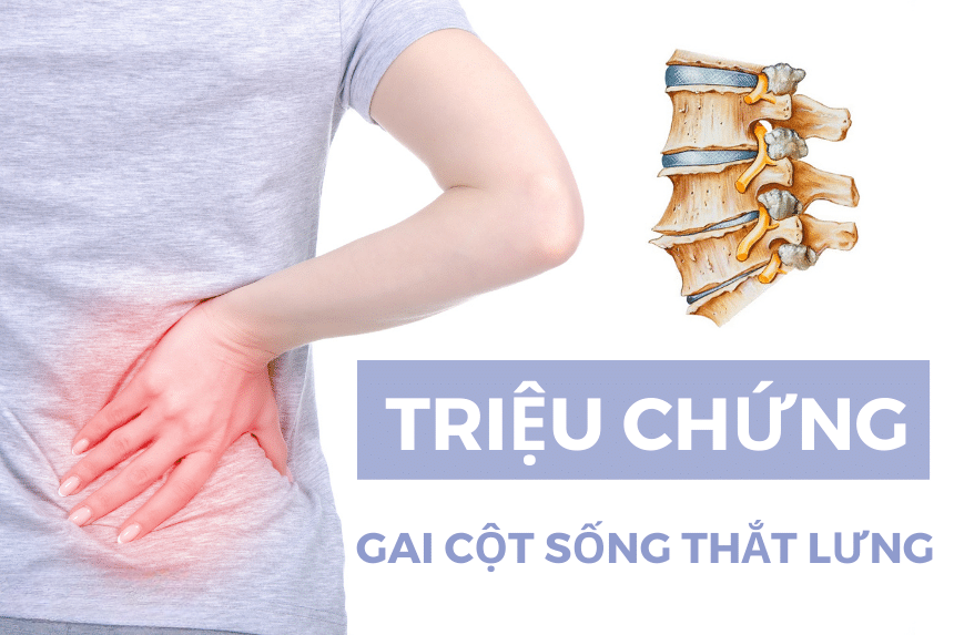 Triệu chứng của gai cột sống lưng