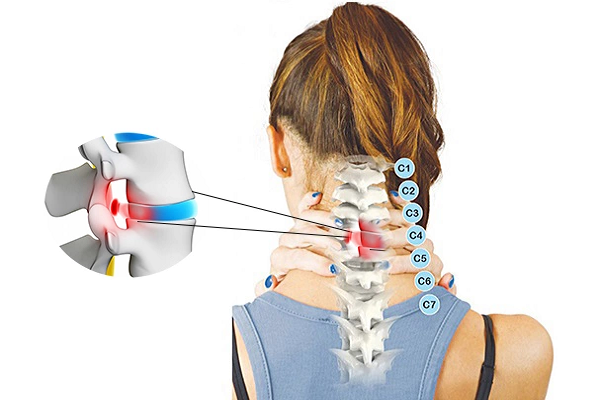 Bệnh thoái hóa đốt sống cổ