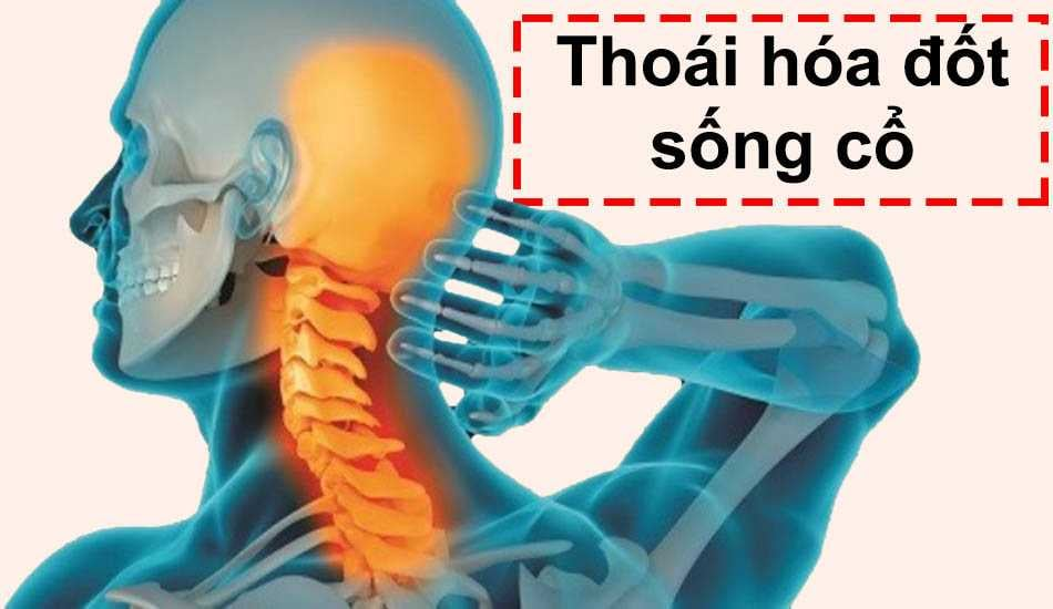 Thoái hóa đốt sống cổ gây thiếu máu não