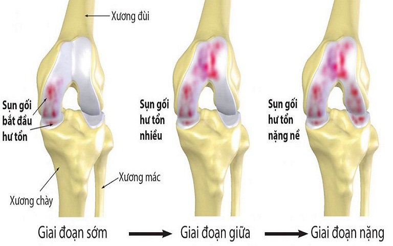 Sai lầm: Điều trị thoái hóa khớp gối theo cách “thiếu mới cung cấp” canxi