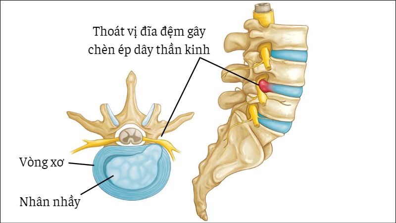 Thoát vị đĩa đệm là gì?
