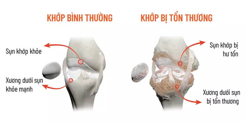 Sai lầm: Điều trị thoái hóa khớp gối theo cách “thiếu mới cung cấp” canxi
