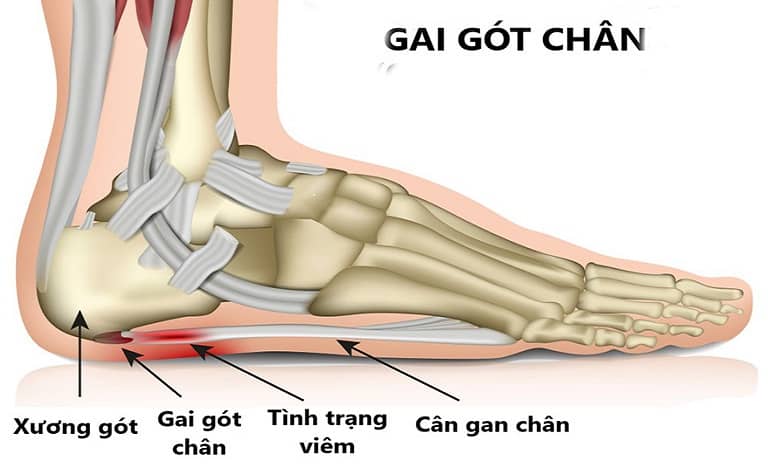 Gai gót chân là gì?