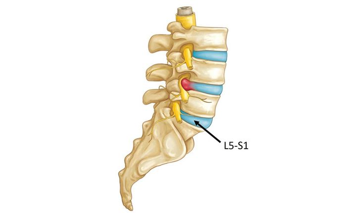 Thoát vị đĩa đệm thắt lưng L5 - S1