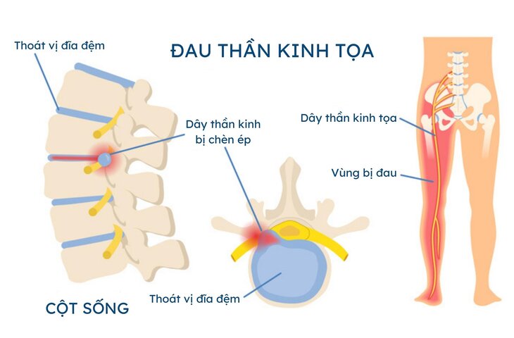 Đau thần kinh tọa là gì?