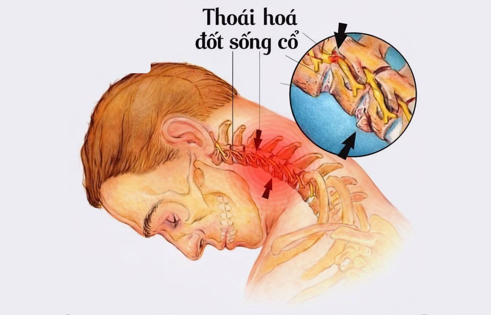 Thoái hóa đốt sống cổ có chữa khỏi được không? CLICK NGAY!