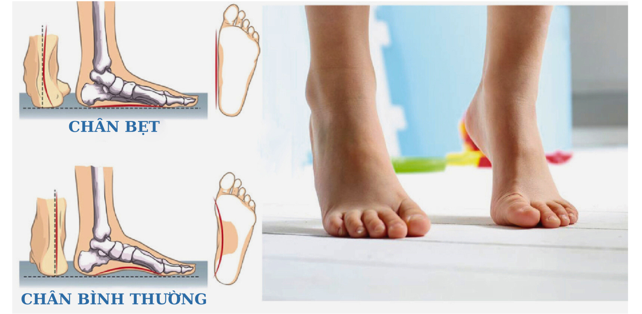 Bàn chân bẹt ở trẻ là gì? Trẻ bị bàn chân bẹt có nguy hiểm không?