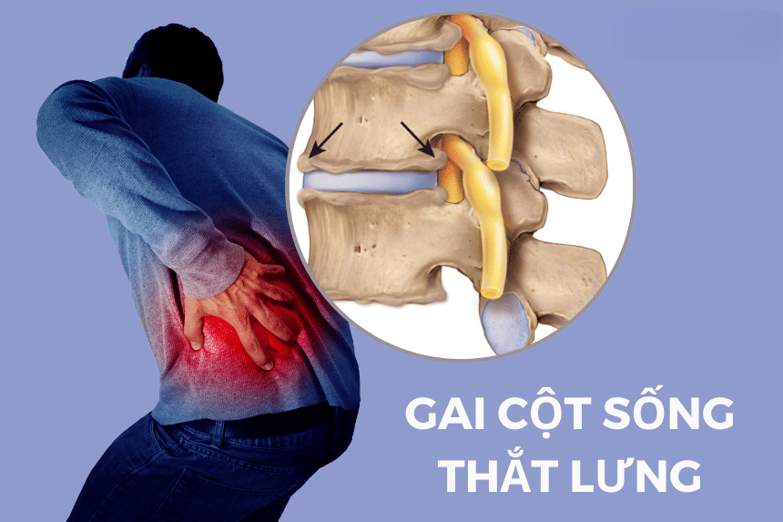 Tê liệt – Biến chứng bệnh gai cột sống thắt lưng ai cũng sợ!