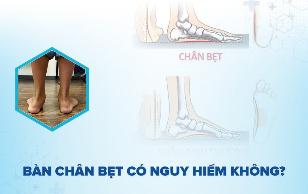 Bàn chân bẹt có nguy hiểm không