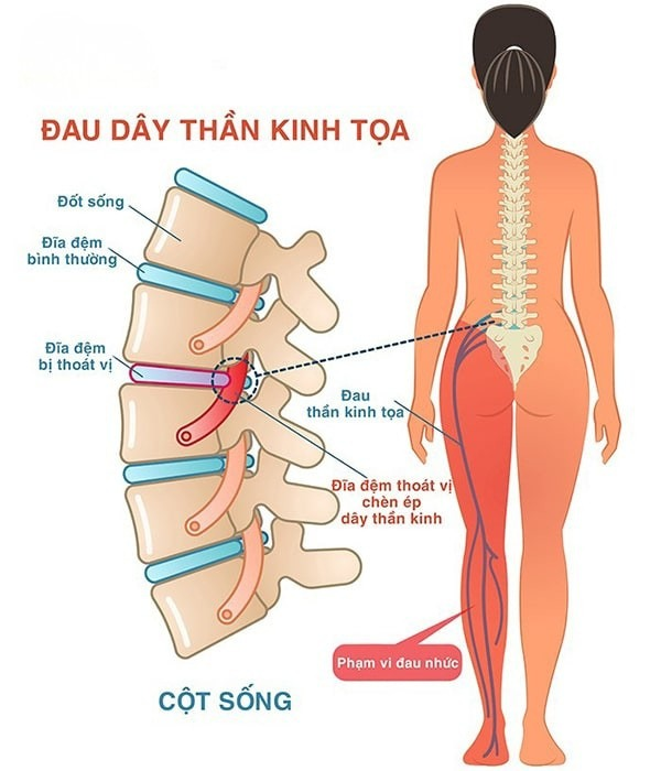 Lệch đĩa đệm cột sống lưng là gì?