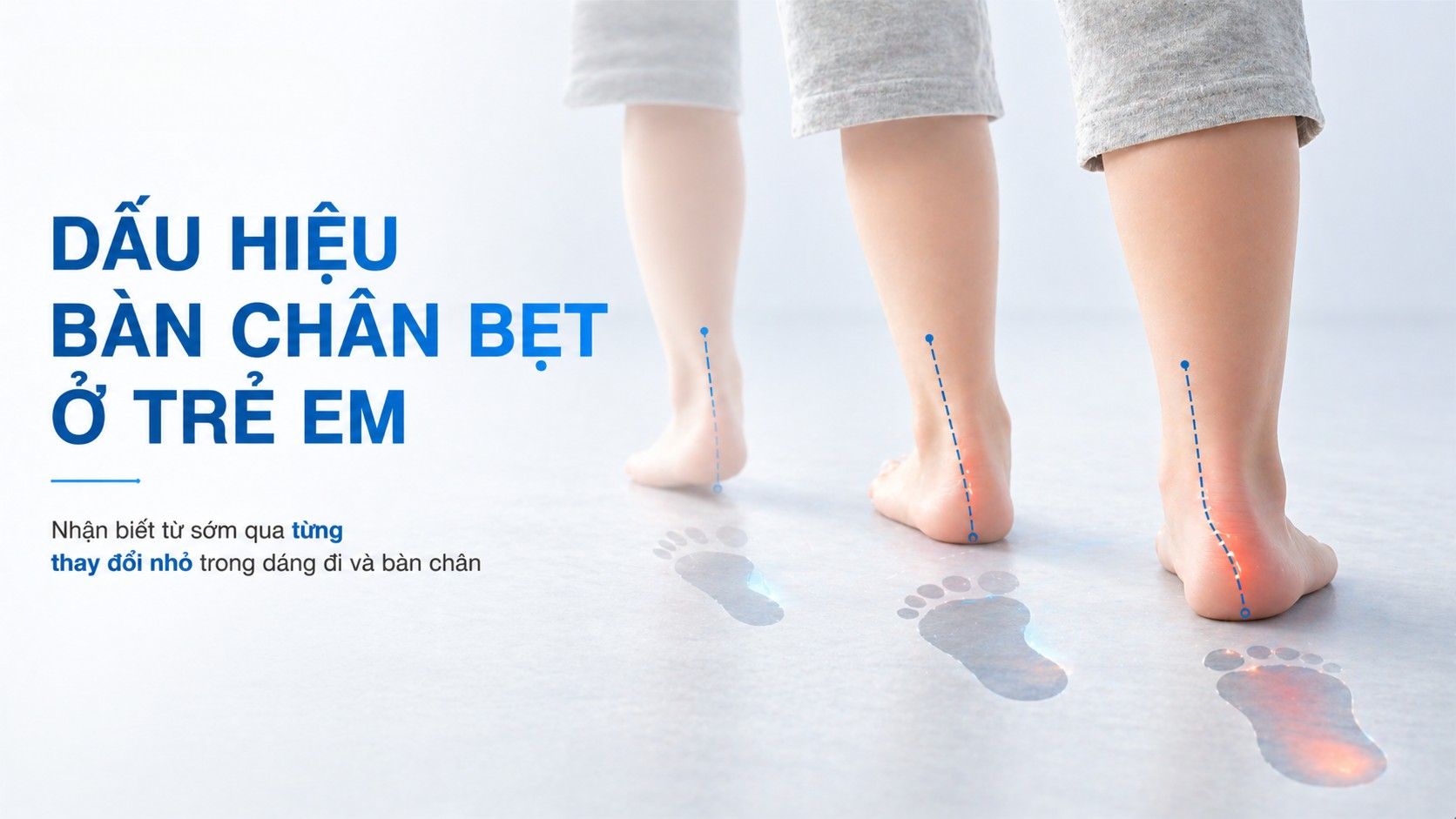 Dấu hiệu bàn chân bẹt ở trẻ em