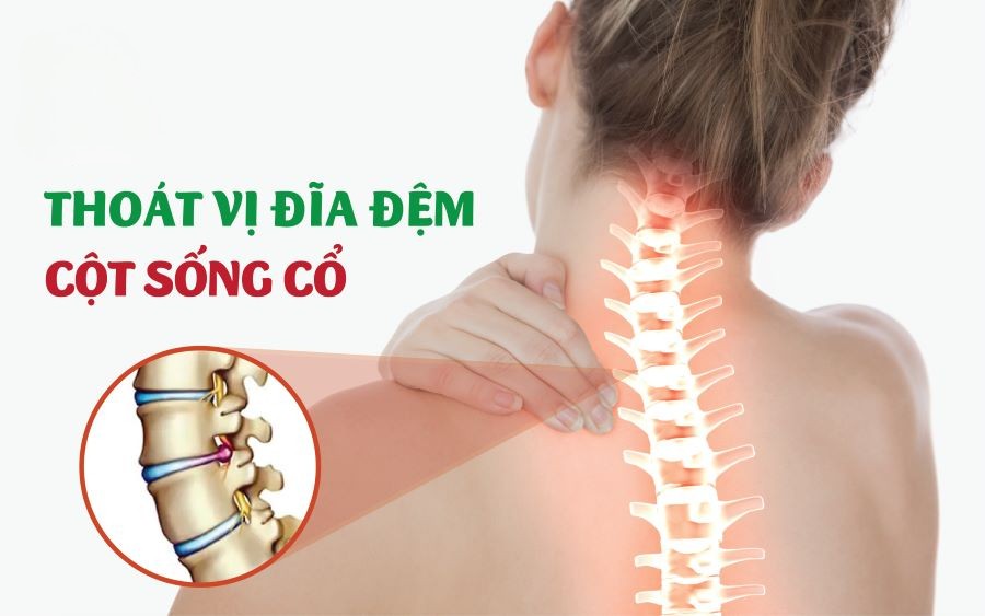 Dấu hiệu thoát vị đĩa đệm cột sống cổ